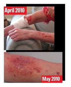 Damaged arm of Mike Rinder’s wife