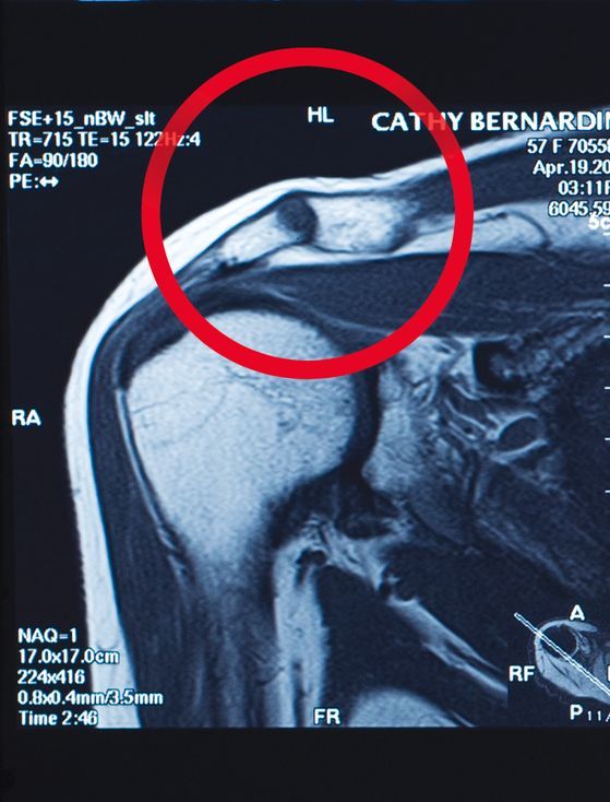 Cathy Rinder shoulder damage