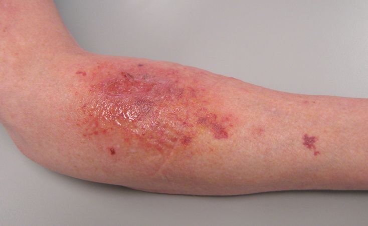 Cathy Bernardini’s lacerated forearm